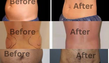 Love Handles before and after pics