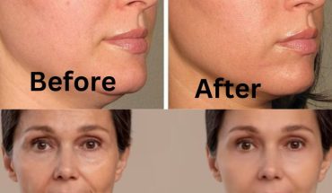 Skin Tightening before and after